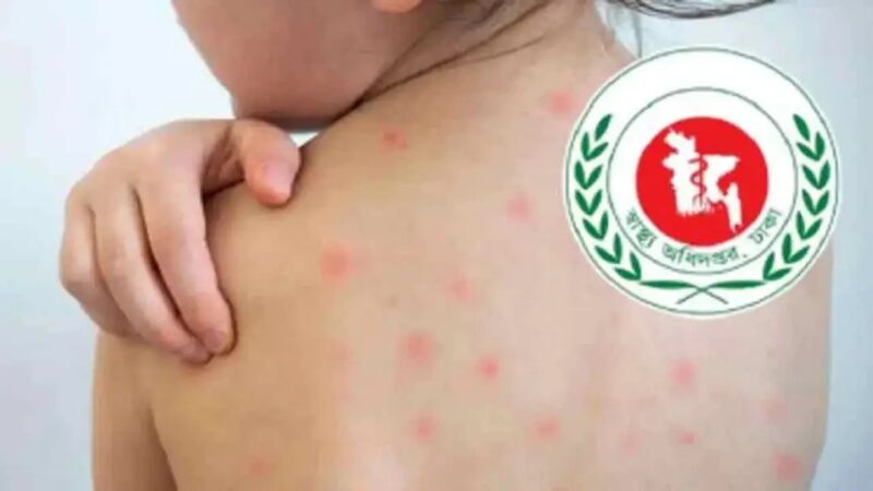 হামের উপসর্গে আরও ৭ মৃত্যু
