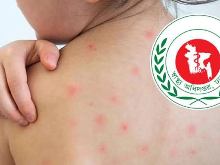 হাম উপসর্গে আরও ৬ মৃত্যু