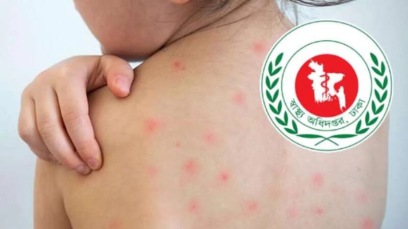 হাম উপসর্গে আরও ৬ মৃত্যু